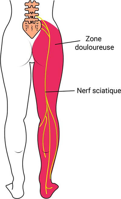 Territoire douloureux du nerf sciatique.