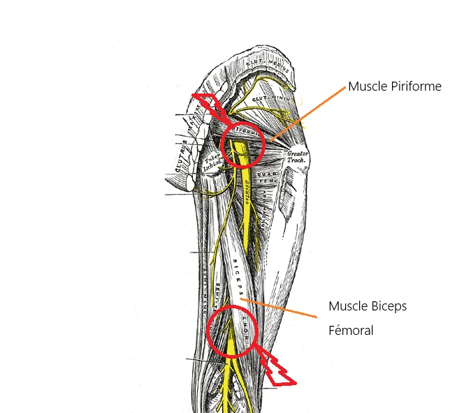 Vue d'ensemble des sites de tronculopathie musculaire du nerf sciatique.