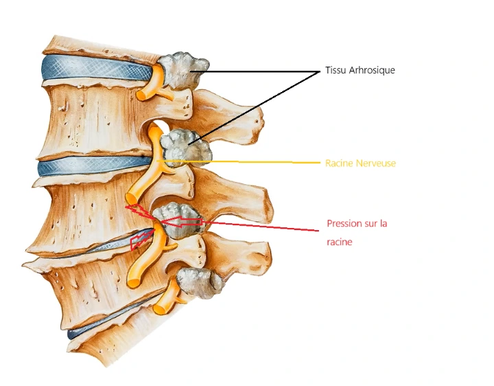 Compression racine nerveuse par de l'arthrose