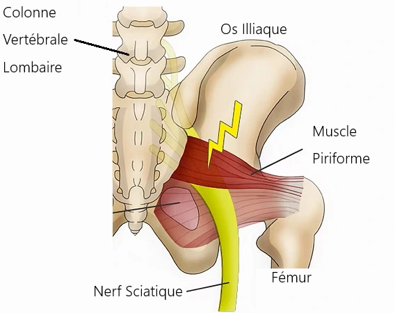 Compression du nerf sciatique par le muscle piriforme.