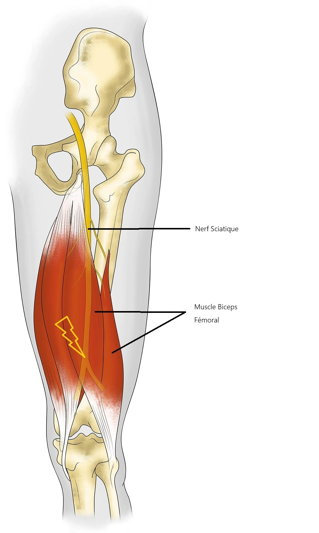 Compression du nerf sciatique par le muscle biceps fémoris.