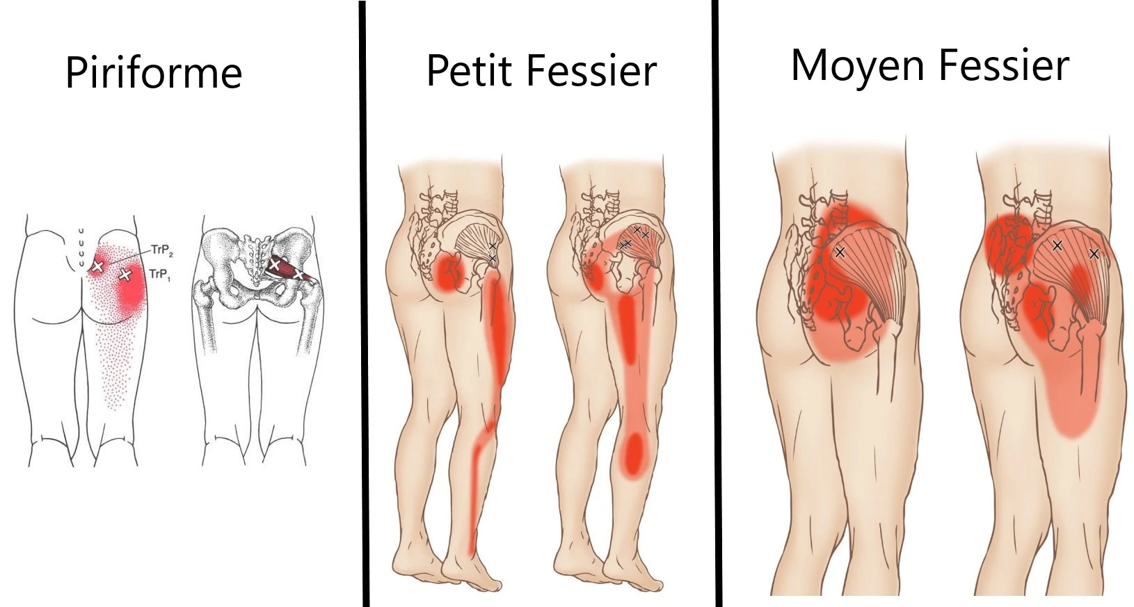 Douleurs référée musuclaires de type sciatalgie.