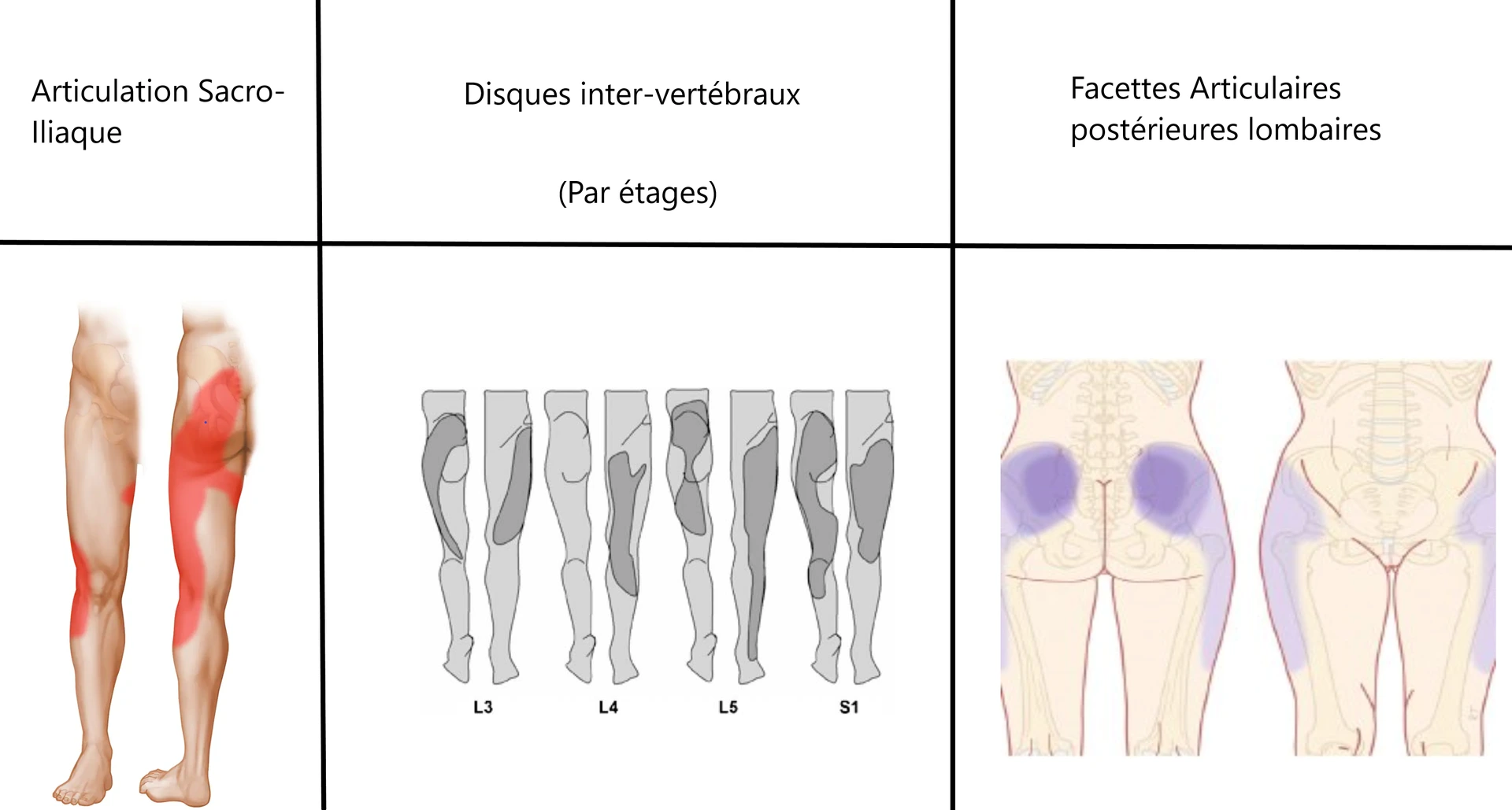 Douleurs référée articulaires de type sciatalgie.